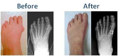 Bunion-Before-and-After