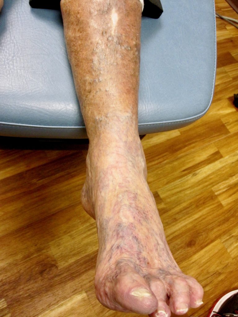 How Long Can You Live With Peripheral Vascular Disease