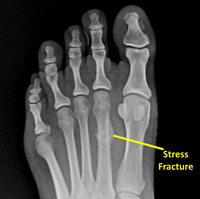 Fractures - Timonium Foot and Ankle Center